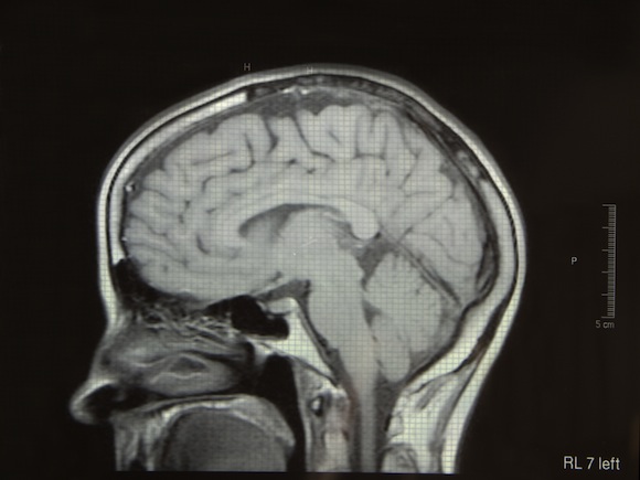 MRI-brain-scan
